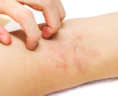 Understanding Eczema: Causes, Symptoms, and How to Manage It